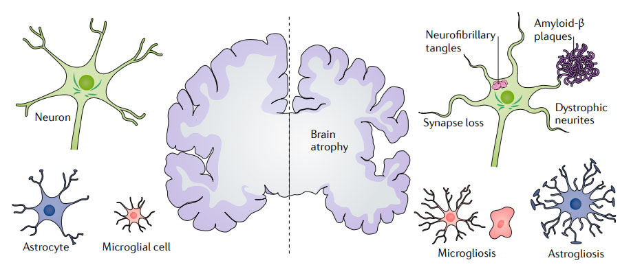 阿尔茨海默症的典型病理特征
