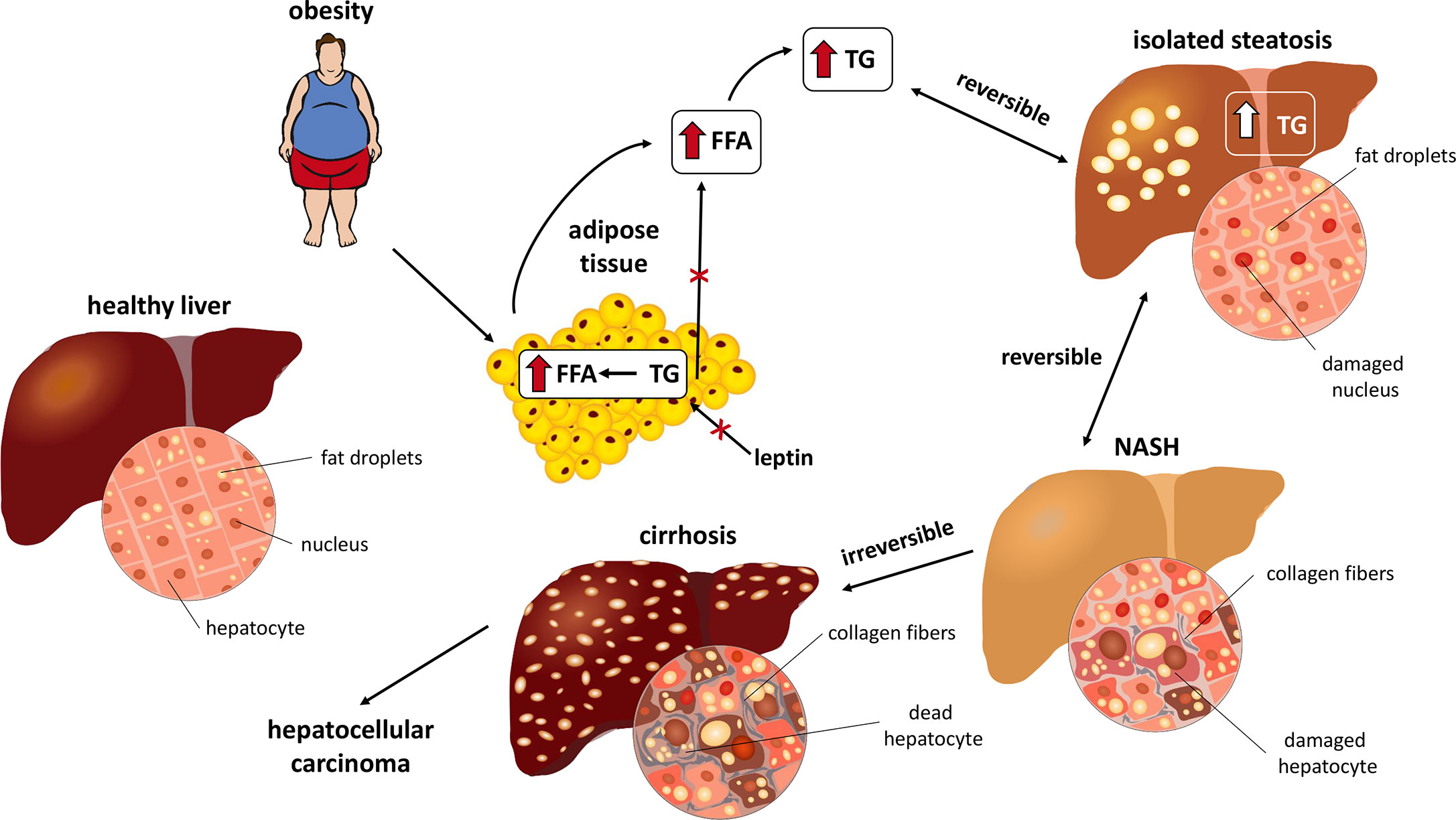 Что такое стеатоз поджелудочной железы. Fatty Liver распространенность. NAFLD Fibrosis score. Стеатоз поджелудочной.